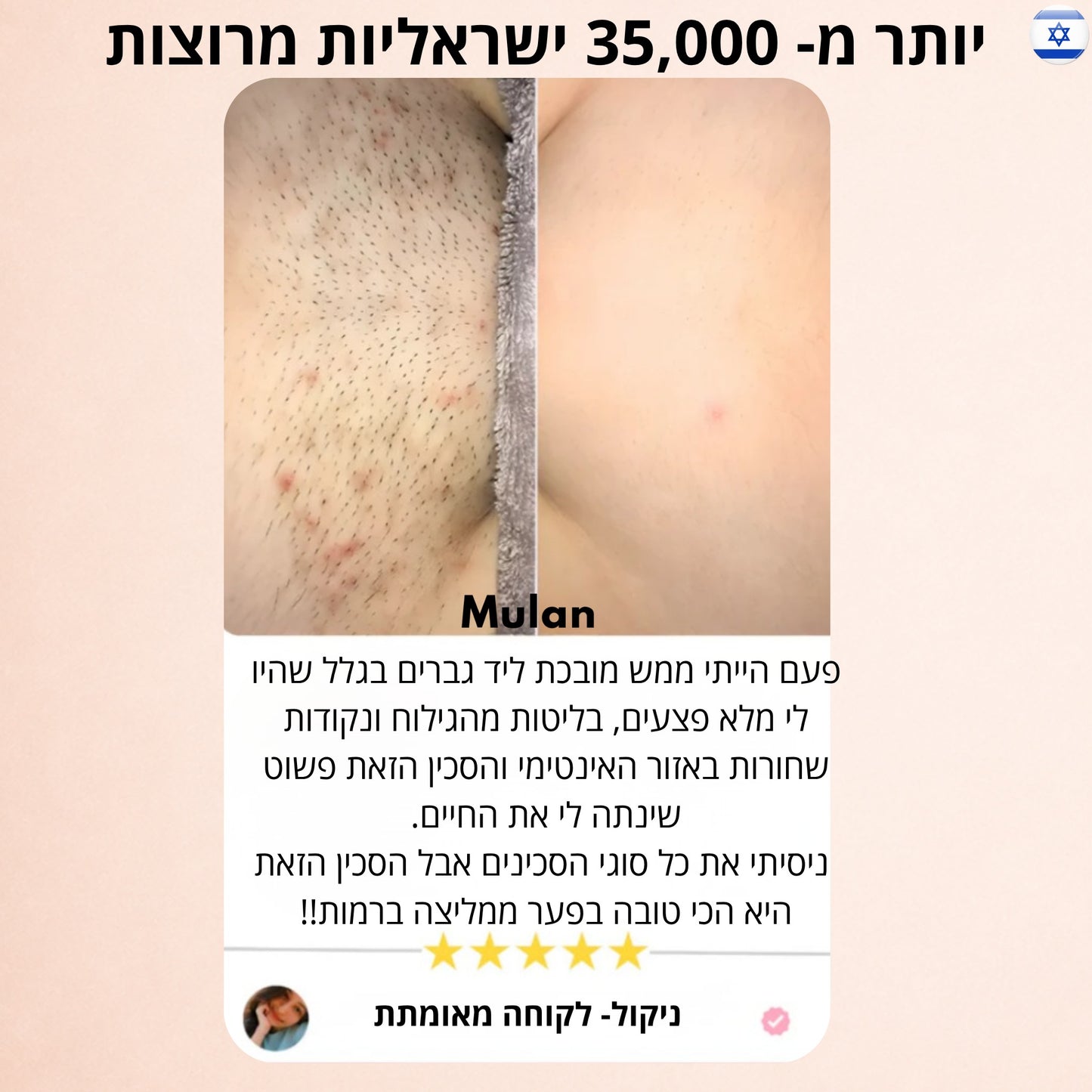 סכין גילוח בטיחותית לנערות למניעת גירוי, בליטות ושיערות חודרנית