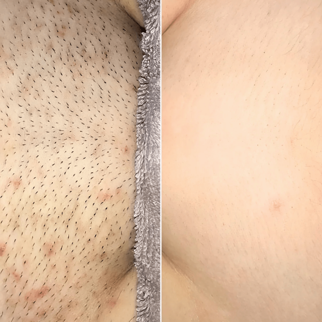 ‬סכין גילוח בטיחותית למניעת גירוי, בליטות ושיערות חודרנית