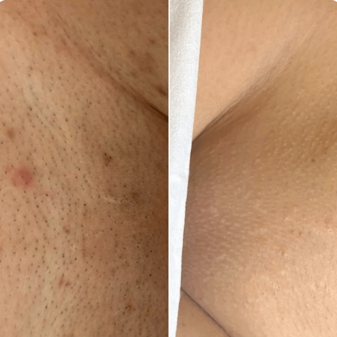 ‬סכין גילוח בטיחותית למניעת גירוי, בליטות ושיערות חודרנית