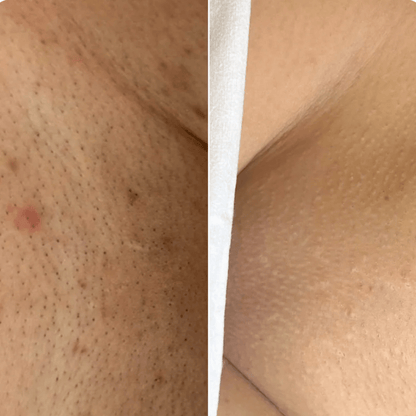 ‬סכין גילוח בטיחותית למניעת גירוי, בליטות ושיערות חודרנית