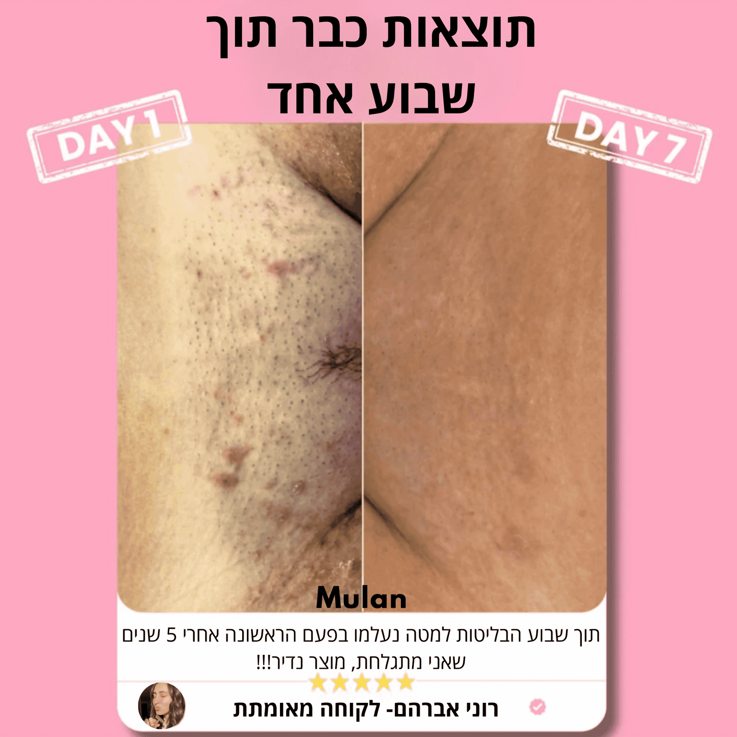 ‬סכין גילוח בטיחותית למניעת גירוי, בליטות ושיערות חודרנית