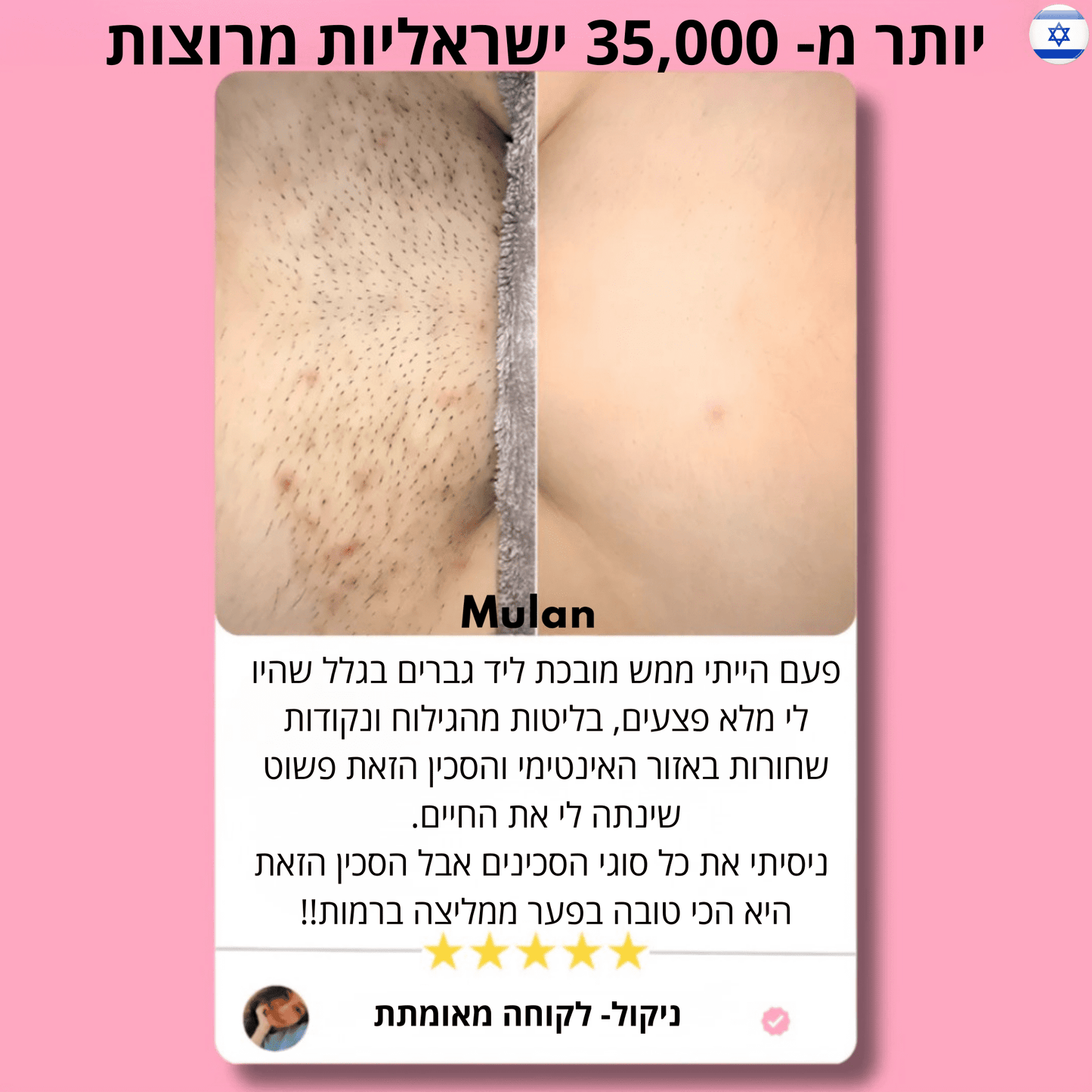 ‬סכין גילוח בטיחותית למניעת גירוי, בליטות ושיערות חודרנית
