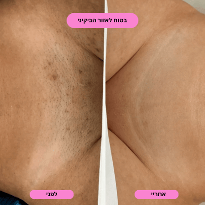 ‬סכין גילוח בטיחותית למניעת גירוי, בליטות ושיערות חודרנית