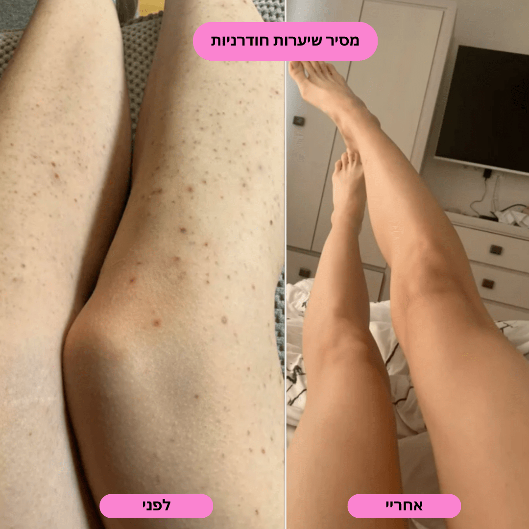 ‬סכין גילוח בטיחותית למניעת גירוי, בליטות ושיערות חודרנית