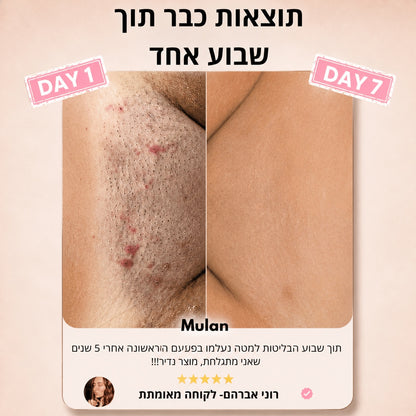 ‬סכין גילוח בטיחותית למניעת גירוי, בליטות ושיערות חודרנית